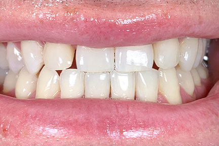 invisalign-bna5-before