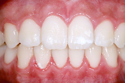 invisalign-bna6-after