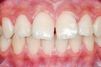 invisalign-bna6-before