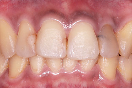 porcelain-bna2-before