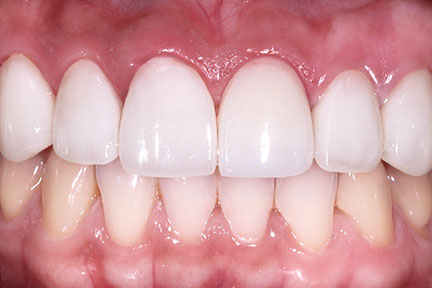 porcelain-veneers-bna1-after