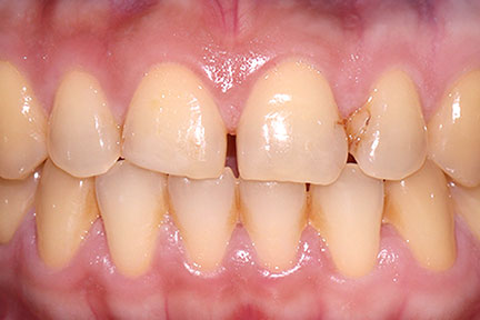 porcelain-veneers-bna1-before