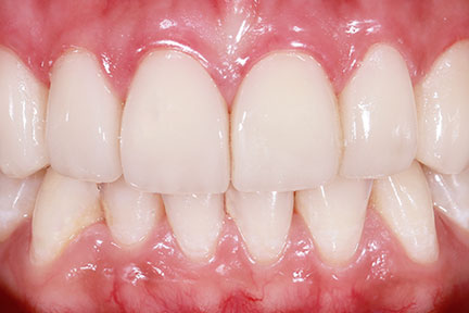 porcelain-veneers-bna3-after