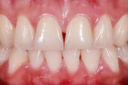porcelain-veneers-bna3-before