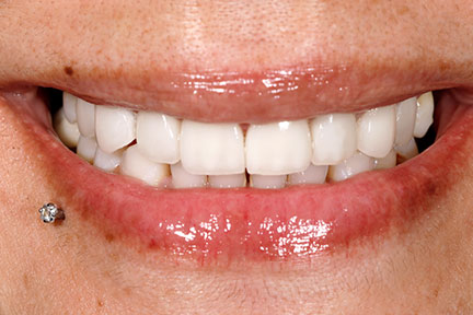porcelain-veneers-bna4-after