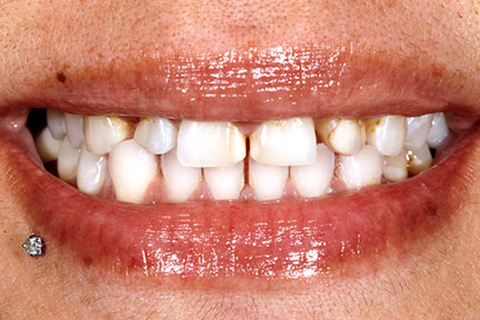 porcelain-veneers-bna4-before