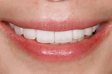 porcelain-veneers-bna5-after