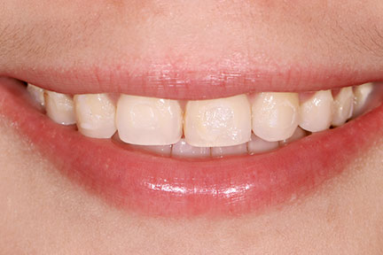 porcelain-veneers-bna5-before