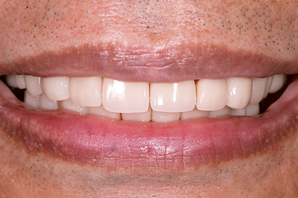 porcelain-veneers-bna6-after