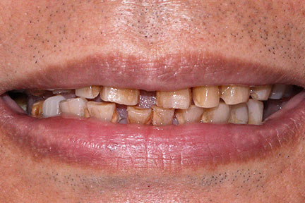 porcelain-veneers-bna6-before