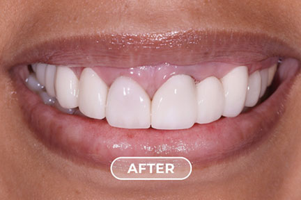 porcelain1-after