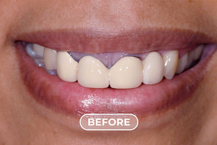 porcelain1-before