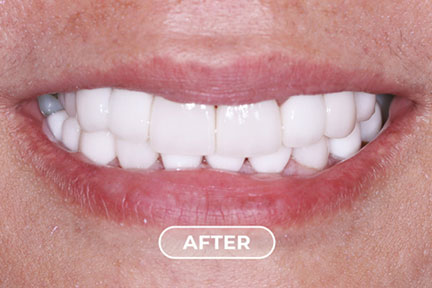 porcelain2-after