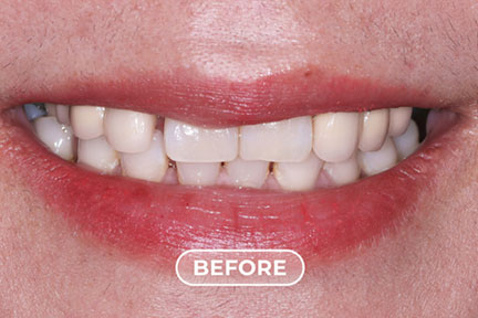 porcelain2-before