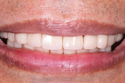 porcelain3-after