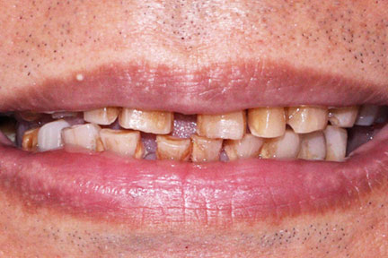 porcelain3-before