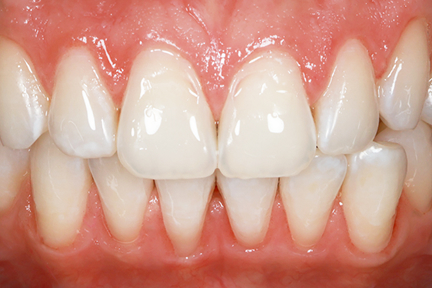 teeth-whitening-bna2-after