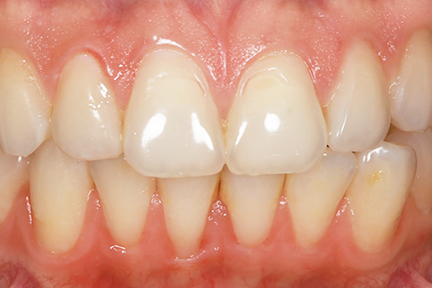 teeth-whitening-bna2-before