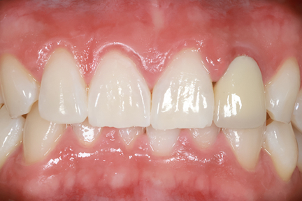 teeth-whitening-bna5-after