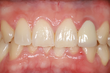teeth-whitening-bna5-before