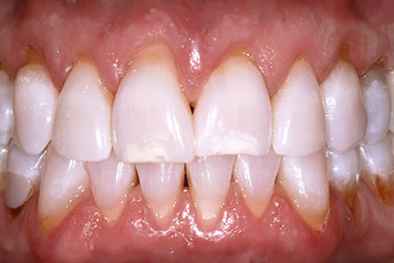 teethwhitening-bna1-after