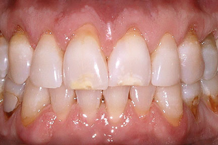 teethwhitening-bna1-before