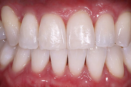 teethwhitening-bna2-after