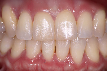 teethwhitening-bna2-before