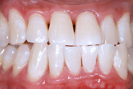 teethwhitening-bna3-after