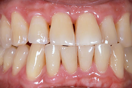 teethwhitening-bna3-before