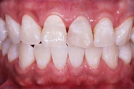 teethwhitening-bna4-after
