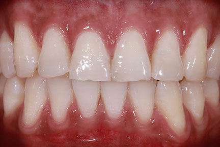 teethwhitening-bna4-after