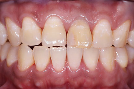 teethwhitening-bna4-before