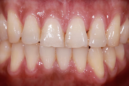 teethwhitening-bna4-before