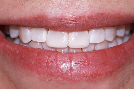 teethwhitening-bna5-after
