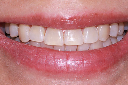 teethwhitening-bna5-before