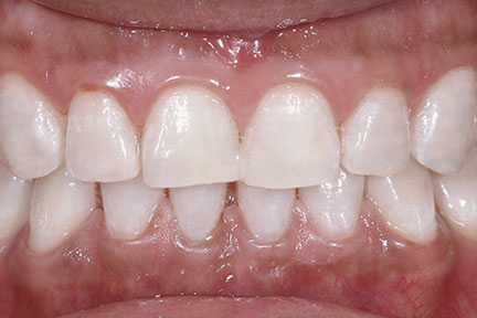 teethwhitening-bna6-after
