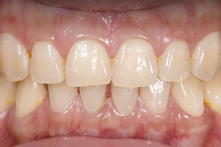 teethwhitening-bna6-before
