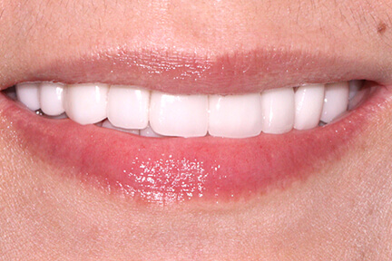 zirconia-bna2-after