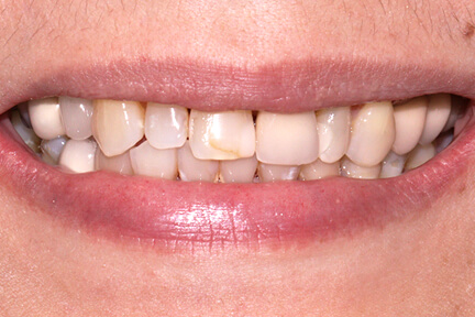 zirconia-bna2-before