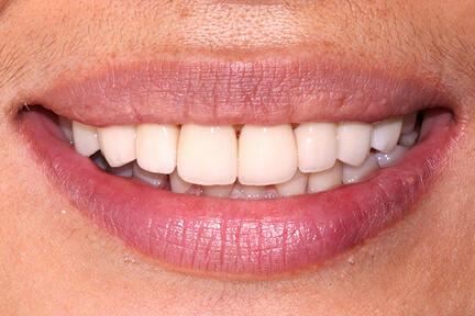 zirconia-bna3-after