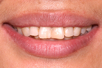zirconia-bna3-before