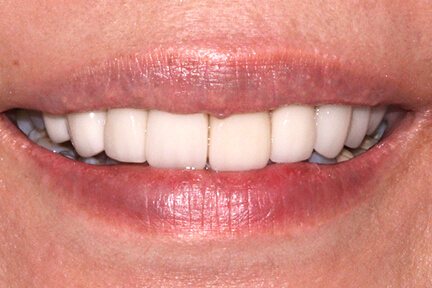 zirconia-bna4-after
