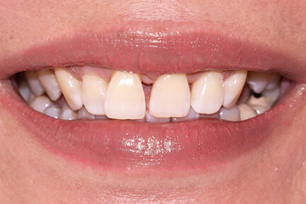 zirconia-bna4-before