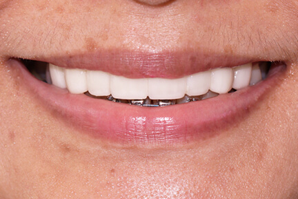 zirconia-bna5-after