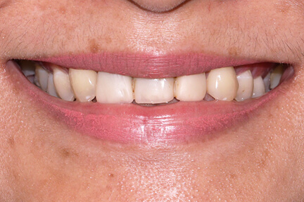 zirconia-bna5-before