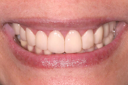 zirconia-bna6-after