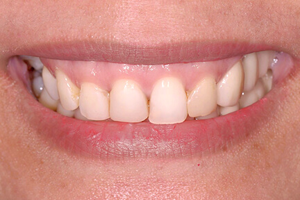 zirconia-bna6-before