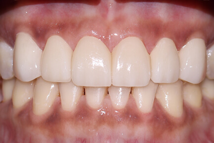 zirconia-veneer-bna1-after