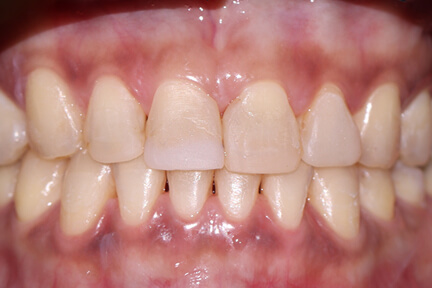 zirconia-veneer-bna1-before